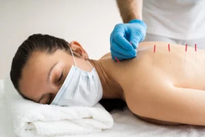 stress relief through an acupuncture therapist
